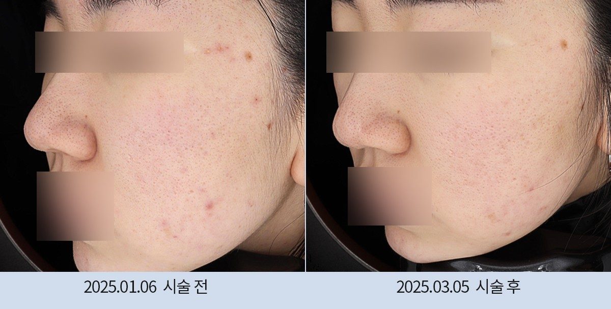 스노우의원 다산점 여드름·붉은기 시술 전후