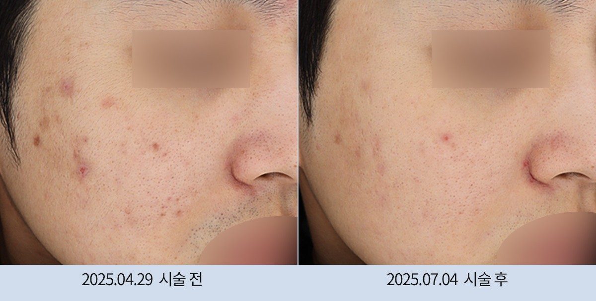 스노우의원 다산점 모공·흉터 시술 전후